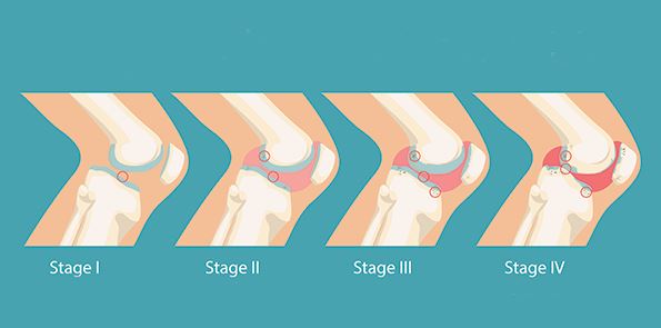 evolution de la gonarthrose